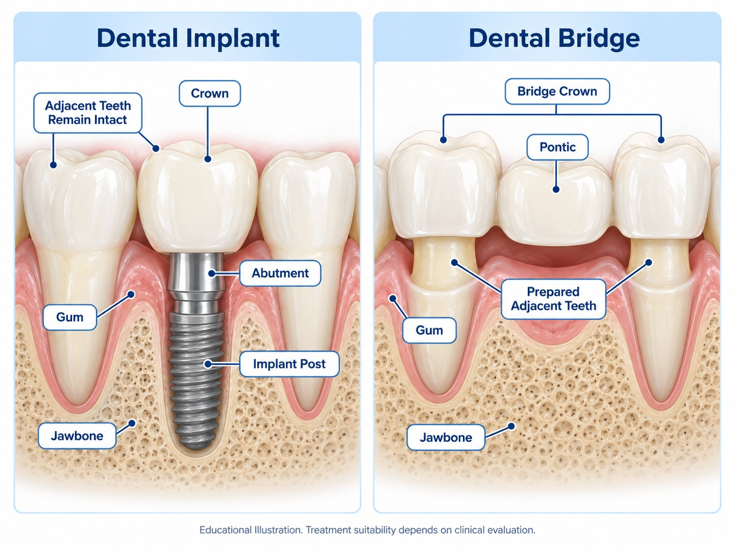 before-after implant